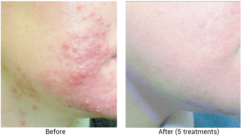 Acne after 5 treatments